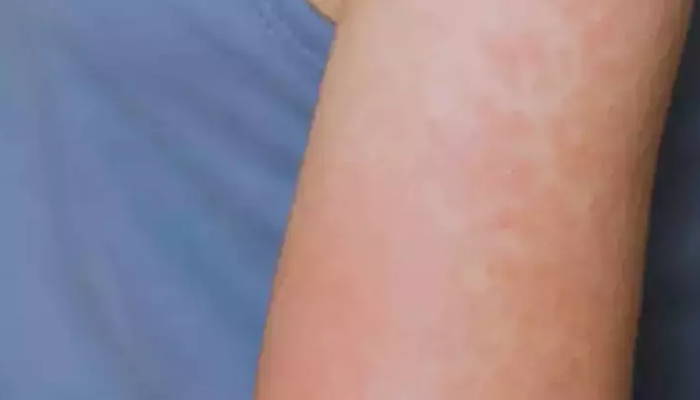 Artan vakalar: kırmızı alarm! Morbillo Teksas'a ve sonra Kansas'a yayıldı