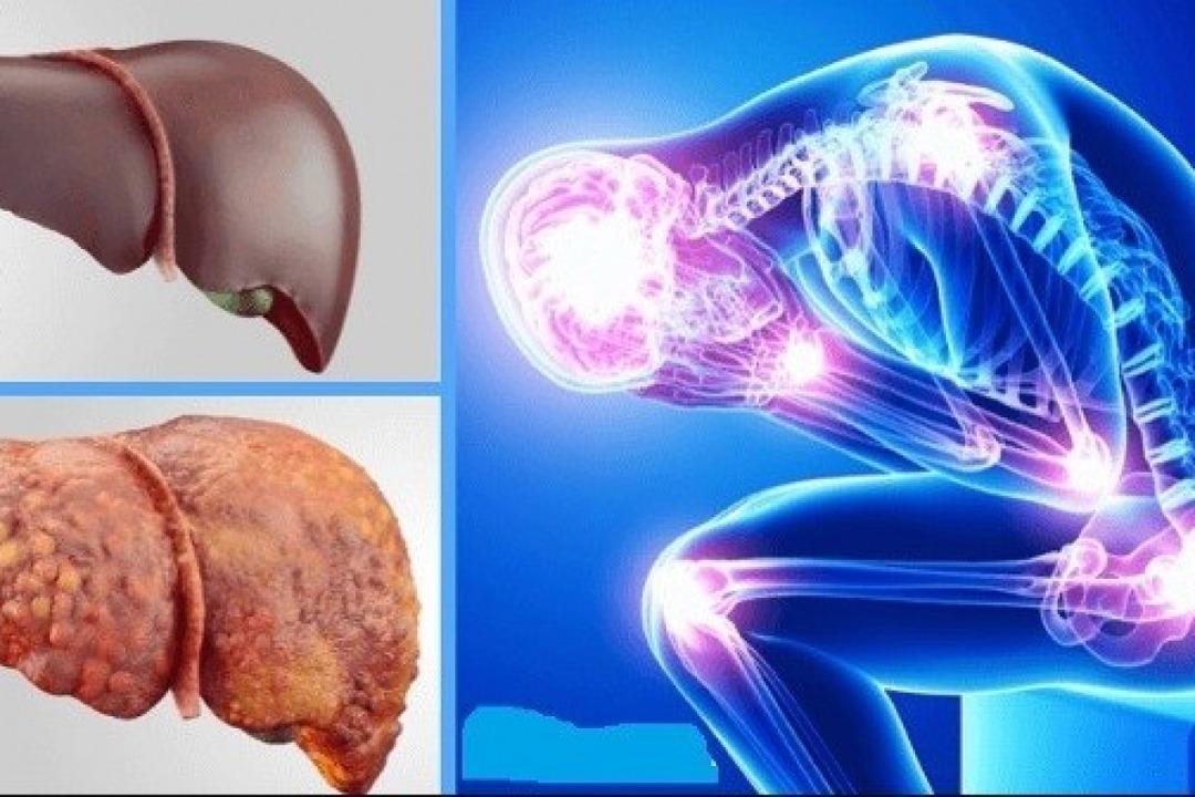 Sessiz Tehlike: Cirrosoz! Uzmandan sirroza uyarı: 